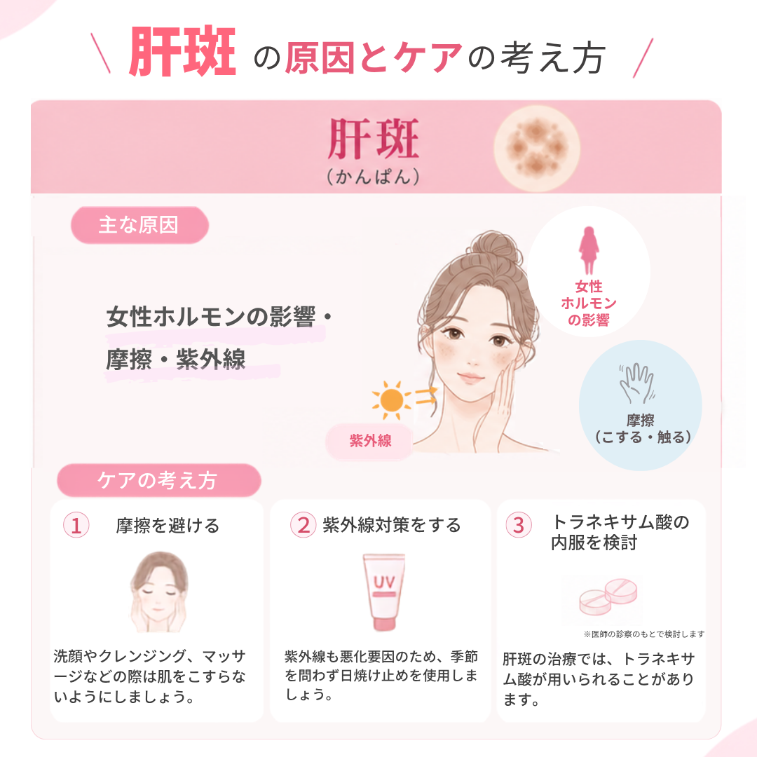 肝斑_原因とケアの考え方_図解 肝斑(かんぱん)の原因とケアの考え方を解説した図解イラスト。原因は女性ホルモンの変動がメラノサイトを刺激し、摩擦や紫外線で悪化すること。ケアは①摩擦を避ける、②紫外線対策をする、③トラネキサム酸などの内服を検討すること。