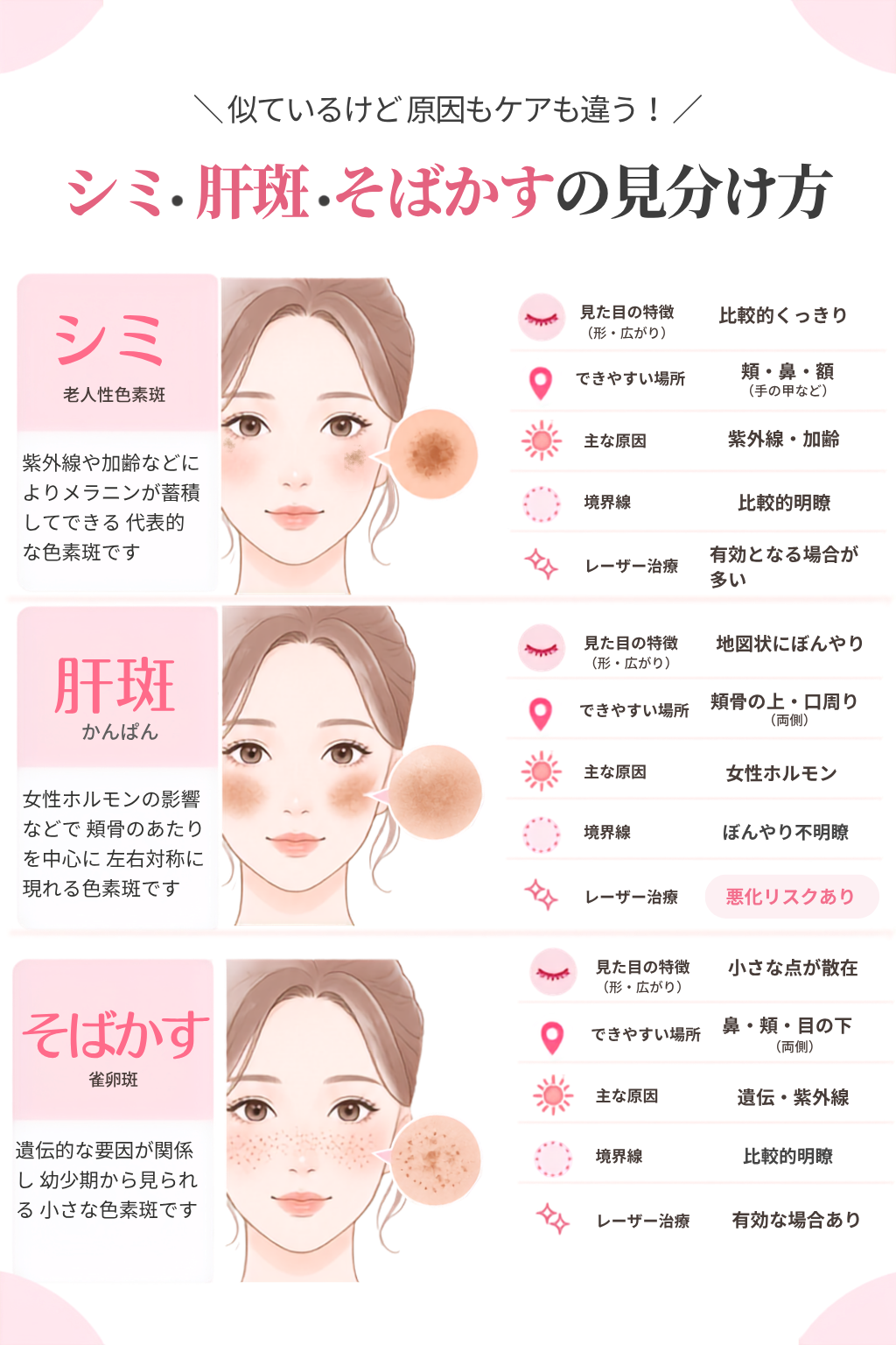 シミ・肝斑・そばかすの見分け方_比較図解_縦型 シミ(老人性色素斑)・肝斑(かんぱん)・そばかす(雀卵斑じゃくらんはん)の見分け方を解説した比較図解イラスト。見た目の特徴、できやすい場所、主な原因、境界線、レーザー治療の適応について解説。